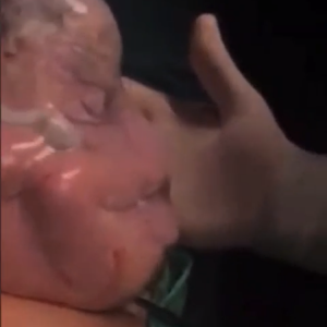 Doğum Esnasında Kese ile Doğan Bebek